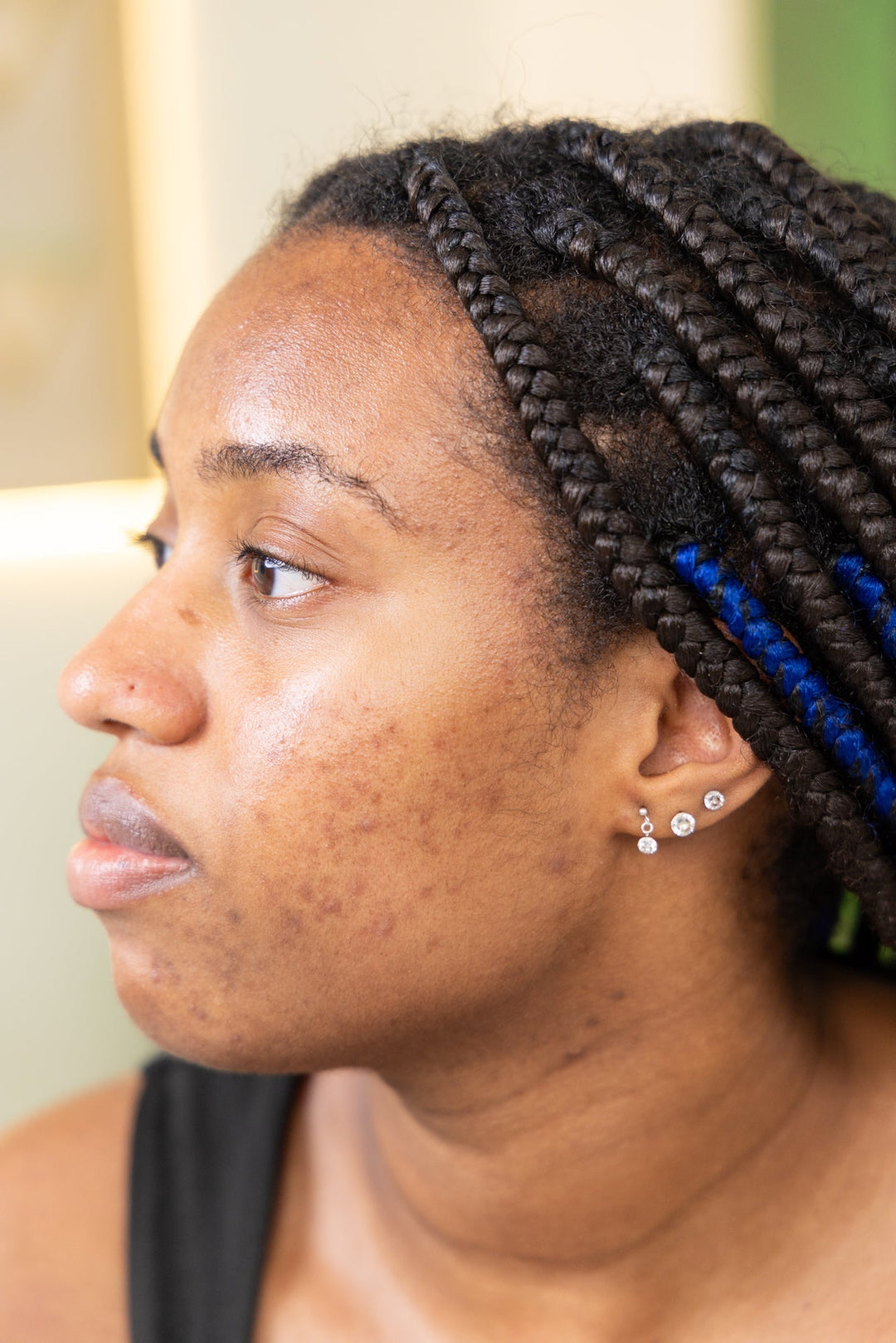 How to Treat Hyperpigmentation on Black Skin