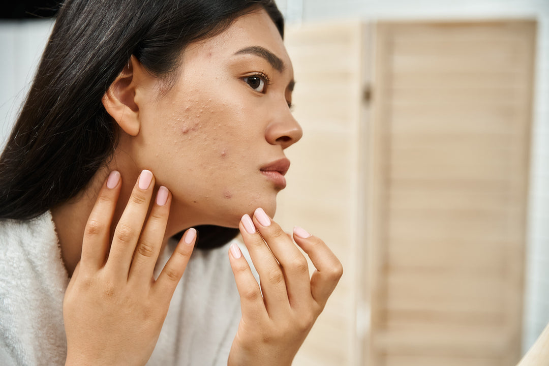 How Acne-Prone Are You?