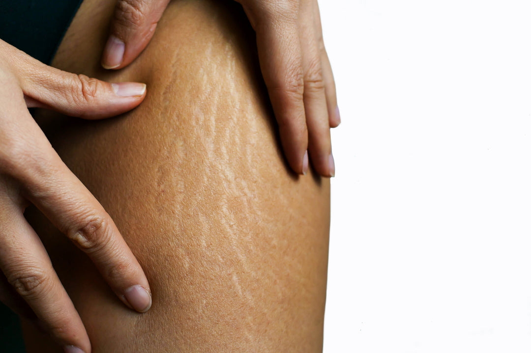 Stretch Marks on Dark Skin: Causes, Prevention and Treatment