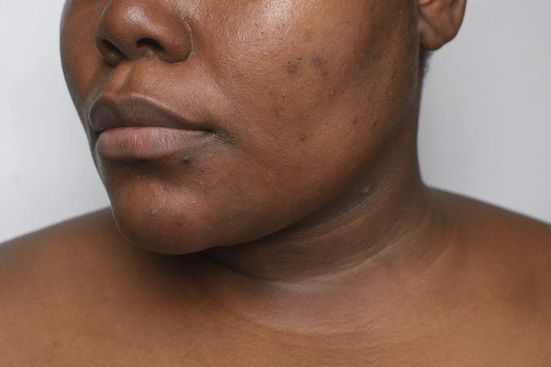 Woman with melanin-rich skin affected by post-acne dark marks