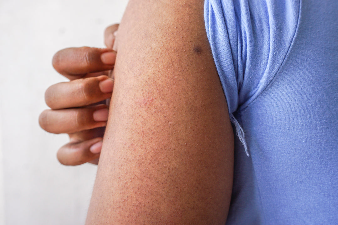Keratosis Pilaris on Skin of Colour