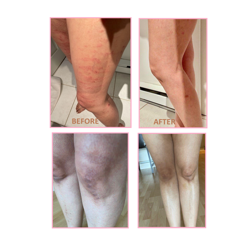 Body Pigmentation Dr. V Body Pigmentation Kit | Hyperpigmentation (dark marks) reduction ...