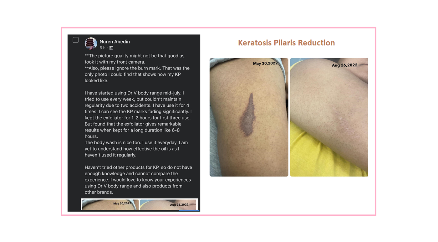 keratosis pilaris reduction with Dr V Body Range
