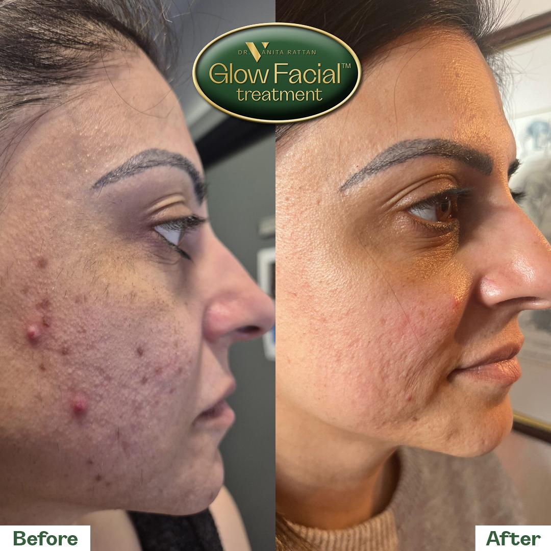 dr_V_facial_before_after_4