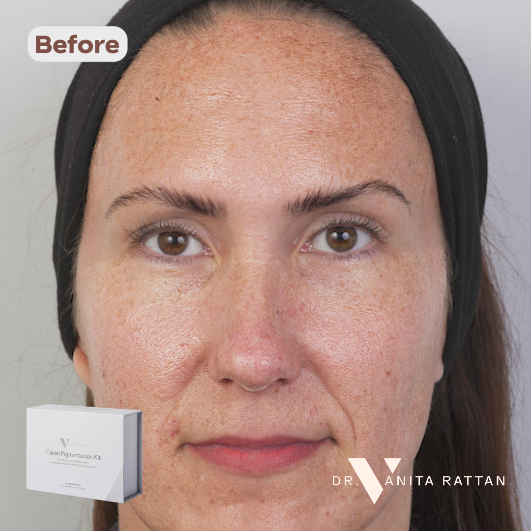 Facial Pigmentation Kit