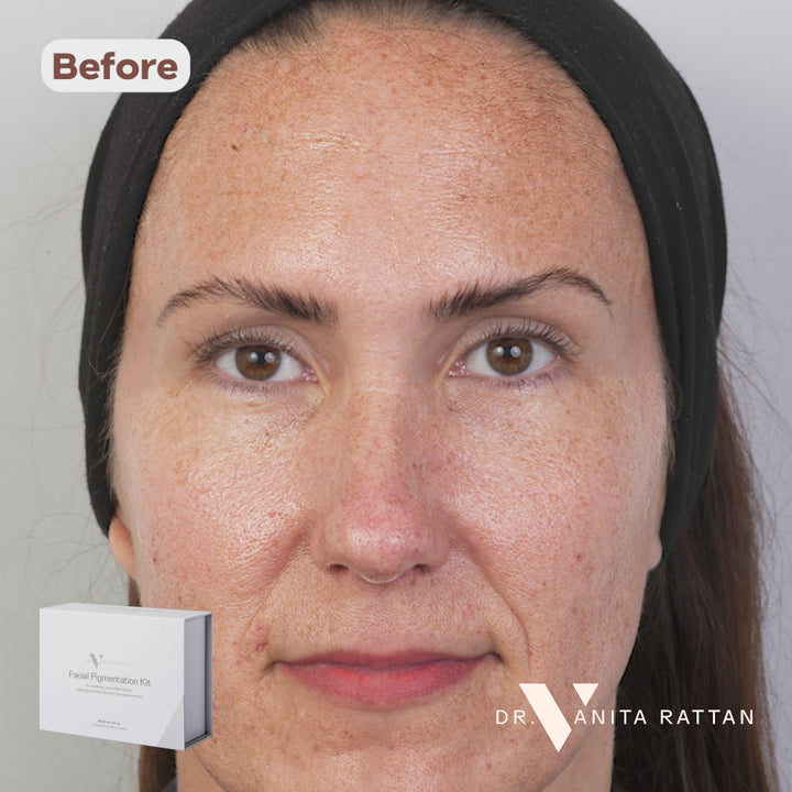 Facial Pigmentation Kit