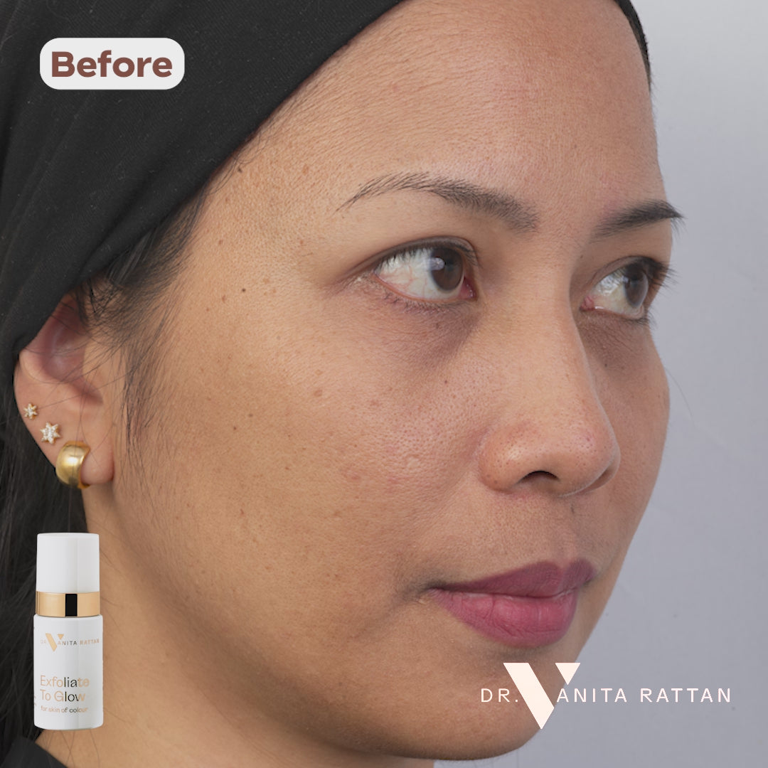 before and After_ExfoliateToGlow slider