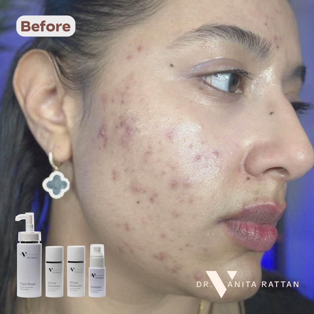 TRIO Blemish Complete Range