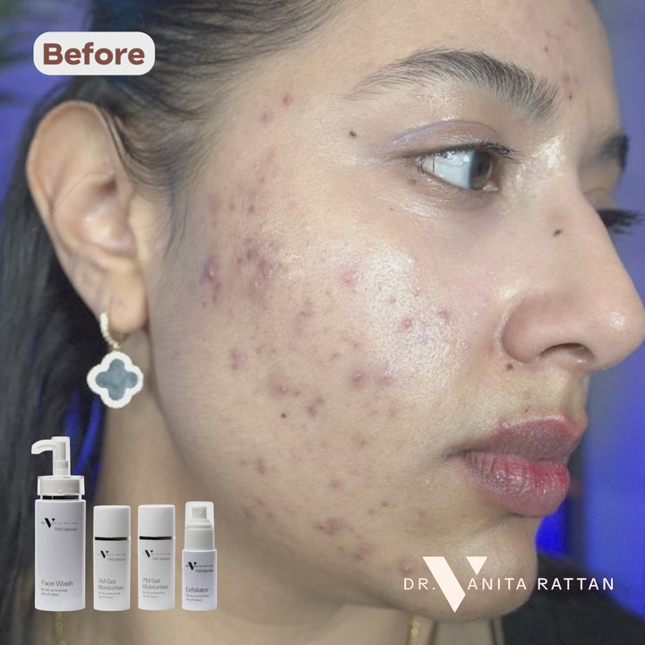 TRIO Blemish Complete Range