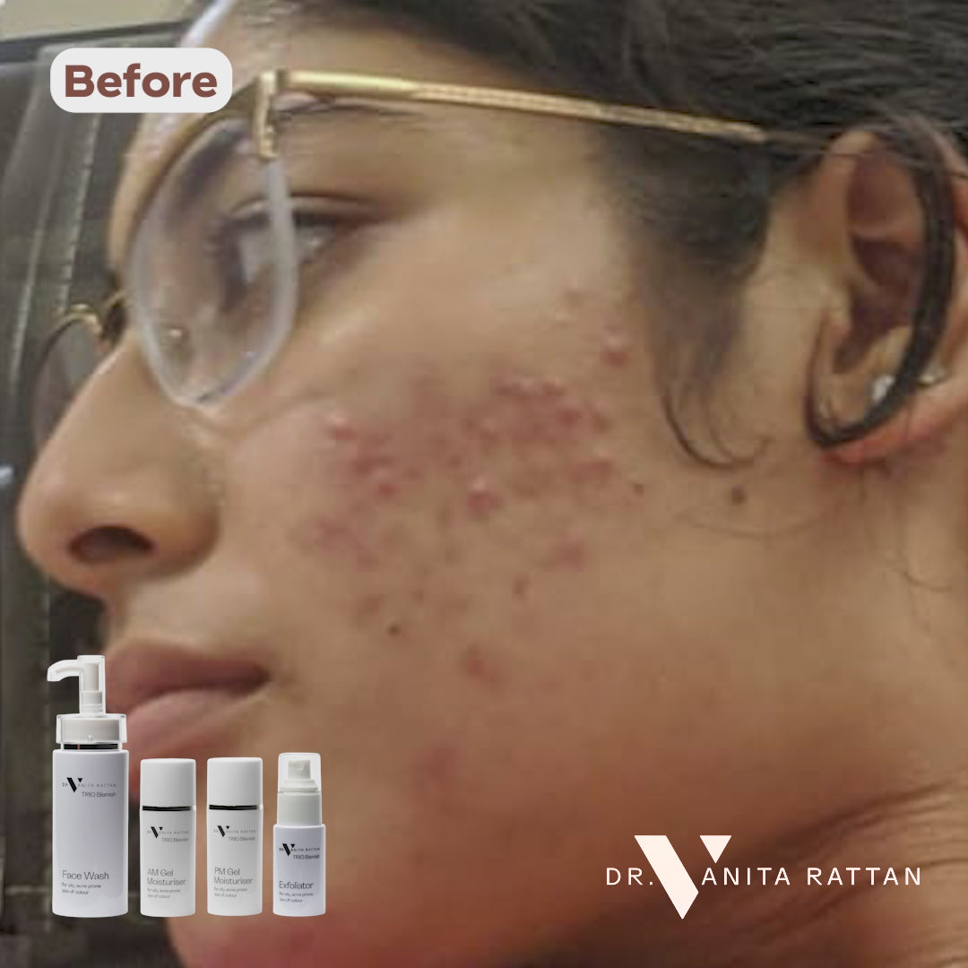 TRIO Blemish Complete Range